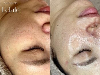 サロンドエクラル(Salon de Eclale wax)/肌質改善で垢抜け肌をゲット◎