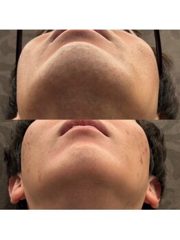 フェリーバ 流山店(FELIVA)/メンズ脱毛はFELIVA