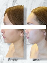 ルミライ(Lumirai)/たるみ改善|毛穴|フェイシャル