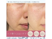 贅沢な生泡美容液×微細針☆SAKURAピールで超保湿◎ハリと毛穴〆