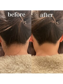 ミノア 大野城店(MINOA)/うなじ脱毛M型ビフォーアフター