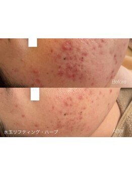 ヴェアリー 広尾(VARY)/ハーブピーリング