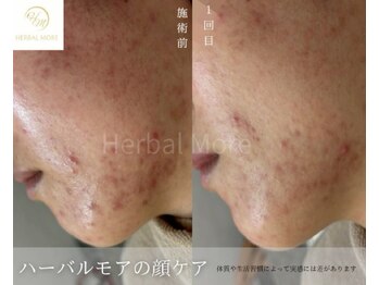 スキニティ 池袋(sknity)/<フェイシャル>肌質整え陶器肌に