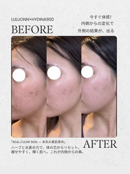 【よもぎ蒸し温活痩身×水素吸入】YOSAPARK ALUA FEM/インナーケアで圧倒的変化