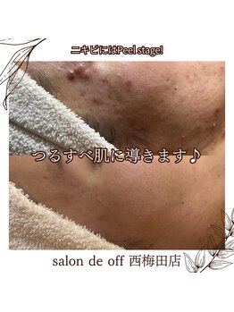 ハリサロンドオフ 西梅田店(hari salon de off)の写真/毛穴・ざらつき・黒ずみを集中ケア*