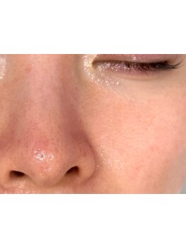 毛穴ケアをしたい