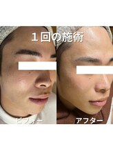 リファラ 光の森店(REFALA)/毛穴・ニキビケア専門REFALA