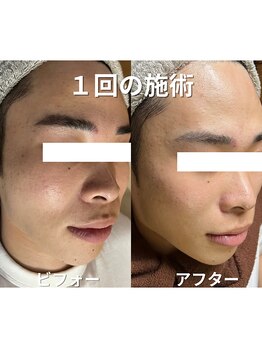 リファラ 光の森店(REFALA)/毛穴・ニキビケア専門REFALA