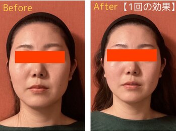 ロイヤリティ(ROYALTY)/左右差、エラ張り、たるみ改善