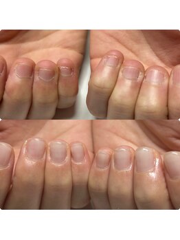 マニュコクーン(ManuCocoon)/爪育成 深爪 巻き爪 大阪市