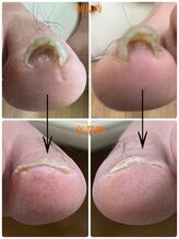 名古屋駅前巻き爪センター/巻き爪