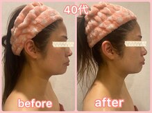 美肌痩身サロン ラエルヴェ(La Elever)/小顔リフトアップ大作戦！ 