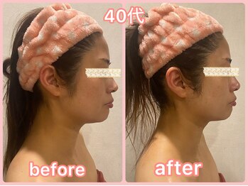 美肌痩身サロン ラエルヴェ(La Elever)/小顔リフトアップ大作戦！ 