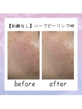 シャルム ココ 八尾店(Charme coco)/剥離なし &nbsp;1回目