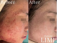 ライム 川崎(LIME)/ハーブピーリング｜ニキビケア