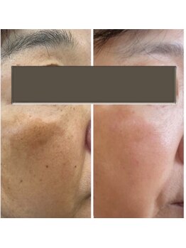 クオーレ(cuore)/シミケアビフォーアフター