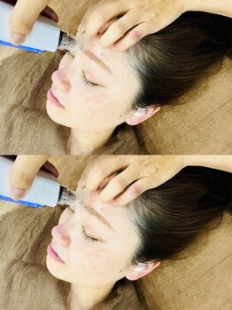 モカラ(MOKARA)の写真/【最先端美容】毛穴の黒ずみやニキビケアなど繰り返す肌トラブルに徹底アプローチ!たるみ改善/ハリ感もUP◎