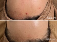 エイプリルフールズ(April fools)/【20代】繰り返す生え際のニキビ