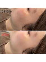 モアビューティー 紙屋町店/【瞬間、水光肌】