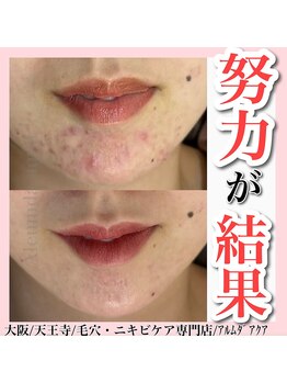 アルムダアクア 天王寺店(Aleumda AQUA)/ハーブピーリング/大阪/天王寺