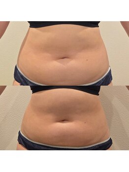 トータルエステティック ジョワイユ(JOYEUX)/お腹&背中ケア