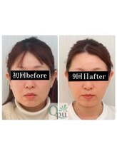 キュープ 浜松店(Qpu)/定期的なお顔のメンテナンスに！