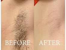 ラヴァコケット あべの店(Lova'coquette)/一度でスッキリツルツルに