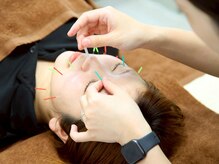 ひまわり整骨院 スポーツ(ひまわり整骨院+SPORTS)/美容鍼でお顔スッキリ