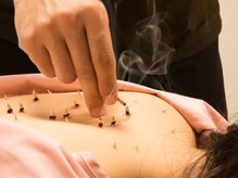 仙灸堂/ ほんわか温かいお灸