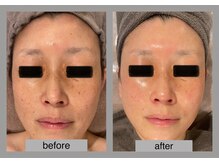 ブリノス(BLINOSS)/シミケアフェイシャル