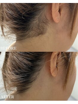 エース(ACE.)/大人気☆うなじ脱毛