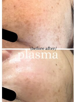 ビー ブルーム(B BLOOM)/【プラズマシミケア】濃淡シミに