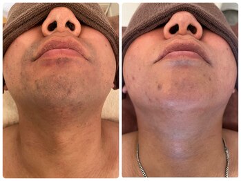 シンデレラ メンズ(Cinderella)/髭脱毛