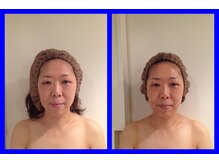 ブルームーン コルギアンドエステティック(Blue moon)/小顔コルギbefore after