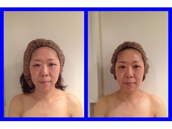 ブルームーン コルギアンドエステティック(Blue moon)/小顔コルギbefore after