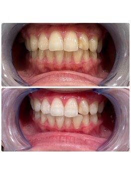 コナホワイトニング 神保町/ホワイトニング