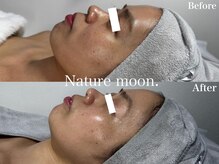 ナチュールムーン(Nature moon.)/ハーブピーリング