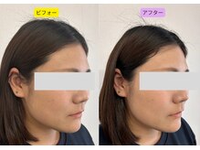りんどう鍼灸院/美容鍼1回施術の変化