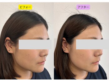 りんどう鍼灸院/美容鍼1回施術の変化