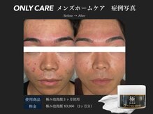 オンリィケア 関大前(ONLY CARE)/【メンズホームケア】