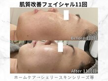 リライン(ReLine)/【リアボーテフェイシャル11回】