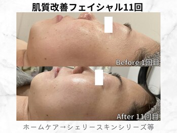 リライン(ReLine)/【リアボーテフェイシャル11回】