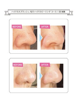 ボーテドゥマリエ(beaute de mariee)/ハイドロピーリング