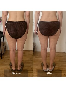 サロンツキ(salon tuki)/【バストアップ】症例★