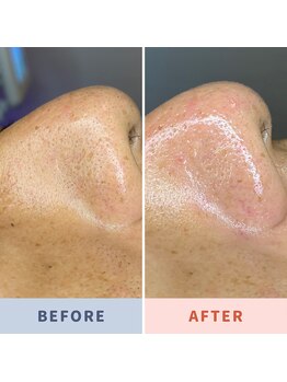 ソリス ビューティー(SOLIS BEAUTY)/毛穴洗浄