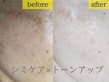 エステの森ジュジュ/【シミケア】ビフォーアフター