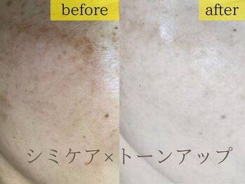 エステの森ジュジュ/【シミケア】ビフォーアフター