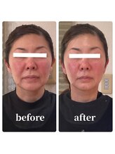 モアナラニ(MoanaLani)/【カーボキシー炭酸ガスパック】