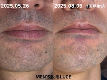 ルーチェ/【ヒゲ脱毛】モニター様