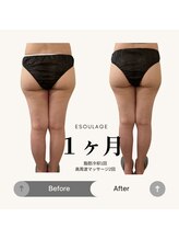 エスラージュ(esoulage)/太もも　脂肪冷却